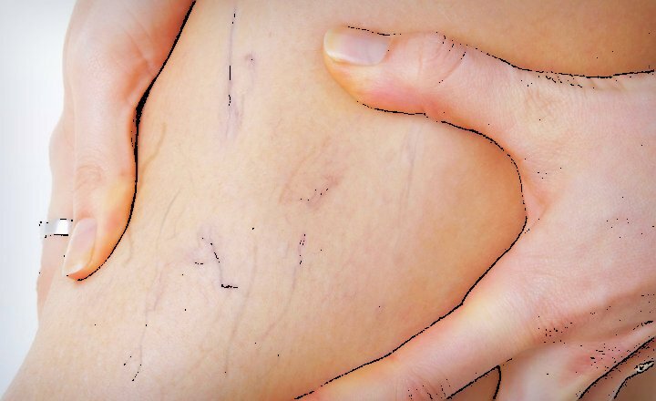 Varices Varices