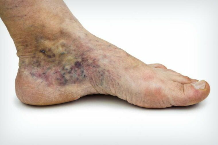 Flebitis Salud