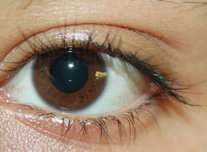 Glaucoma Salud